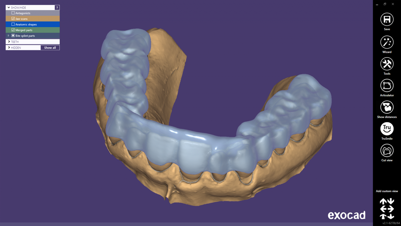 цифровая стоматология, cad cam, элайнеры